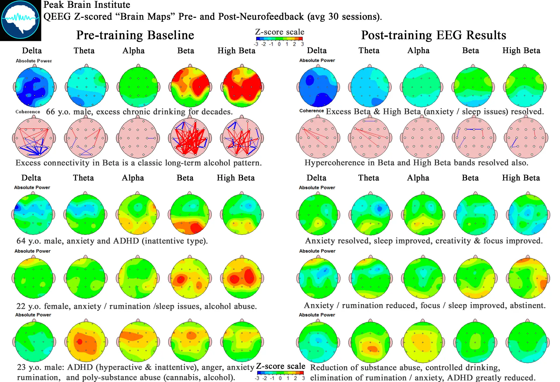 QEEG Progress Demonstration