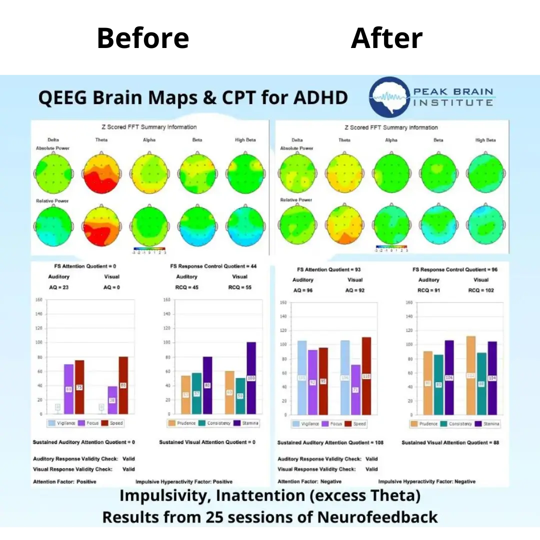 QEEG Example 1 - Before and After Brain Map