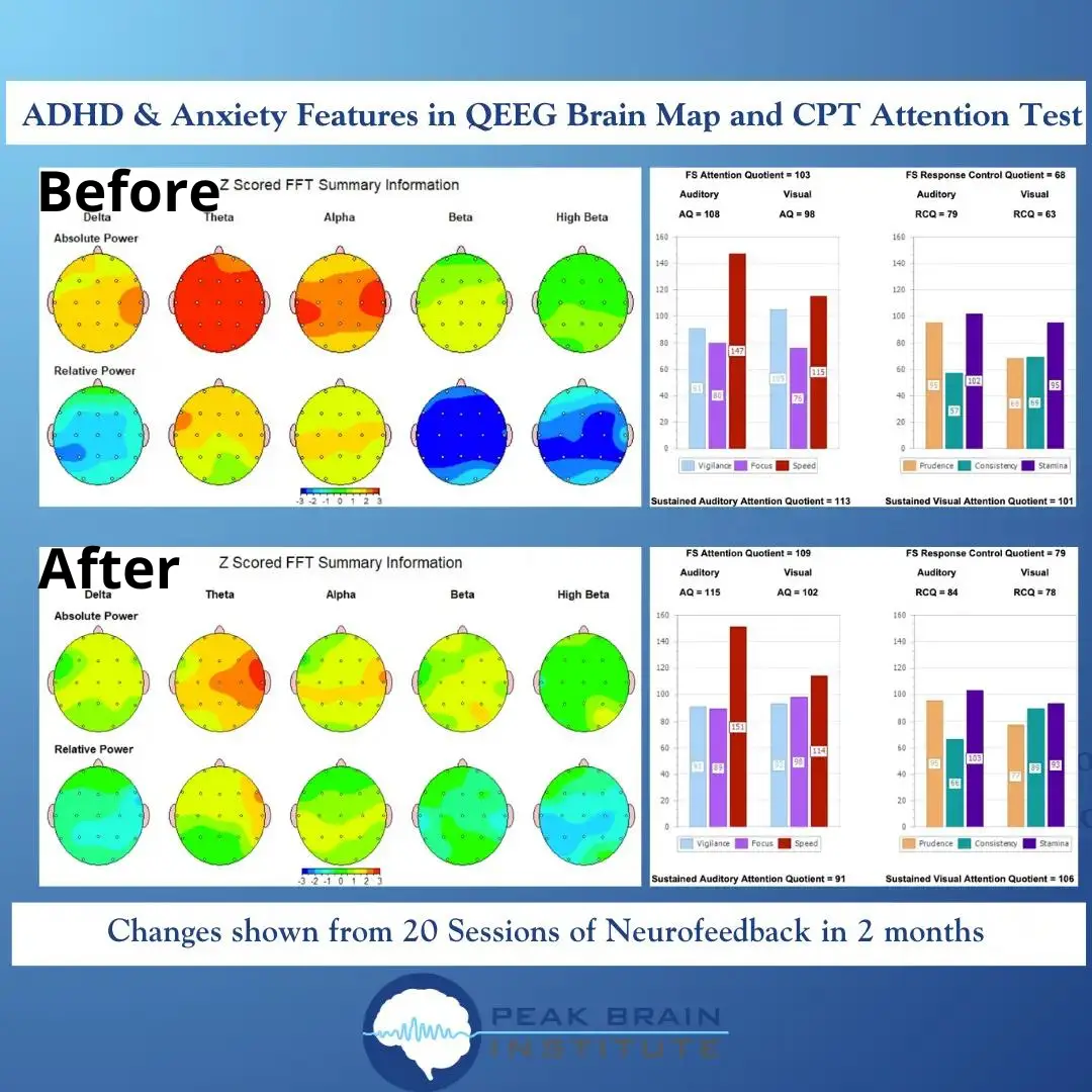 QEEG Example 2 - Before and After Brain Map