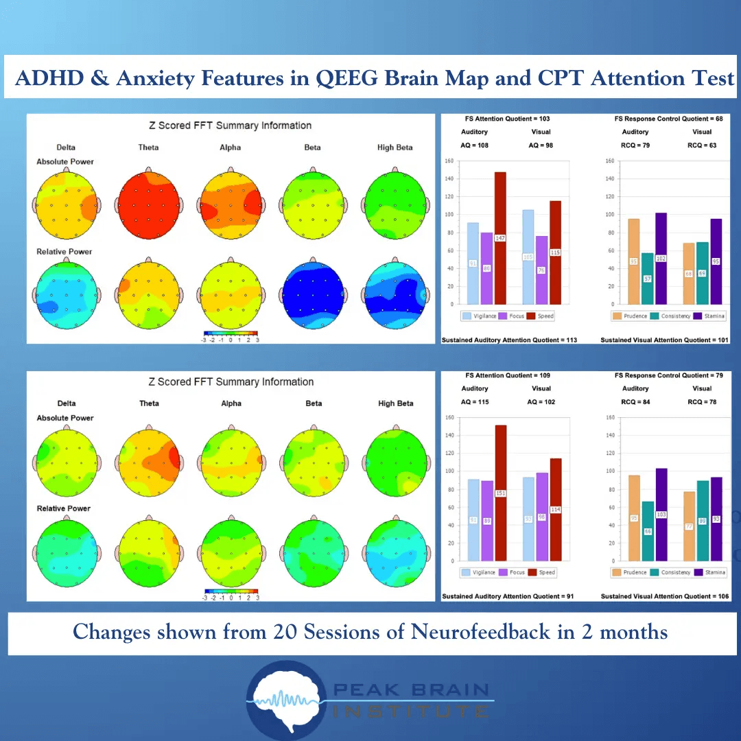 Sample QEEG brain map showing regulation patterns before and after neurofeedback training